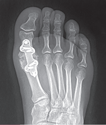 Arthrodesis With a Plate and Screws