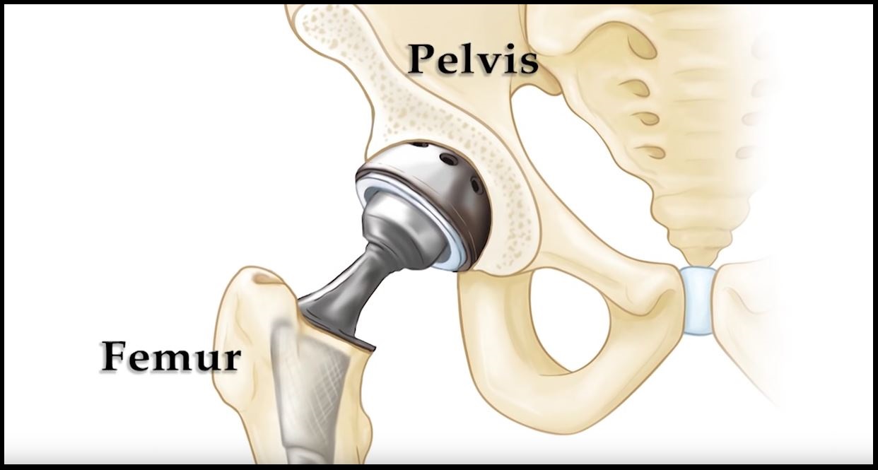 Total hip joint replacement  Download Scientific Diagram