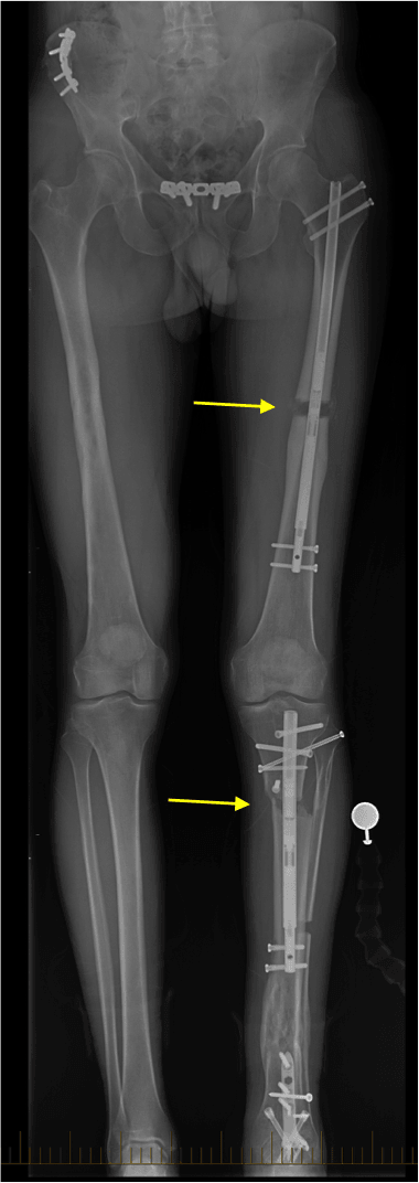 distraction osteogenesis