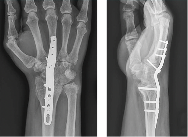 X-rays Showing Wrist Post-Fusion