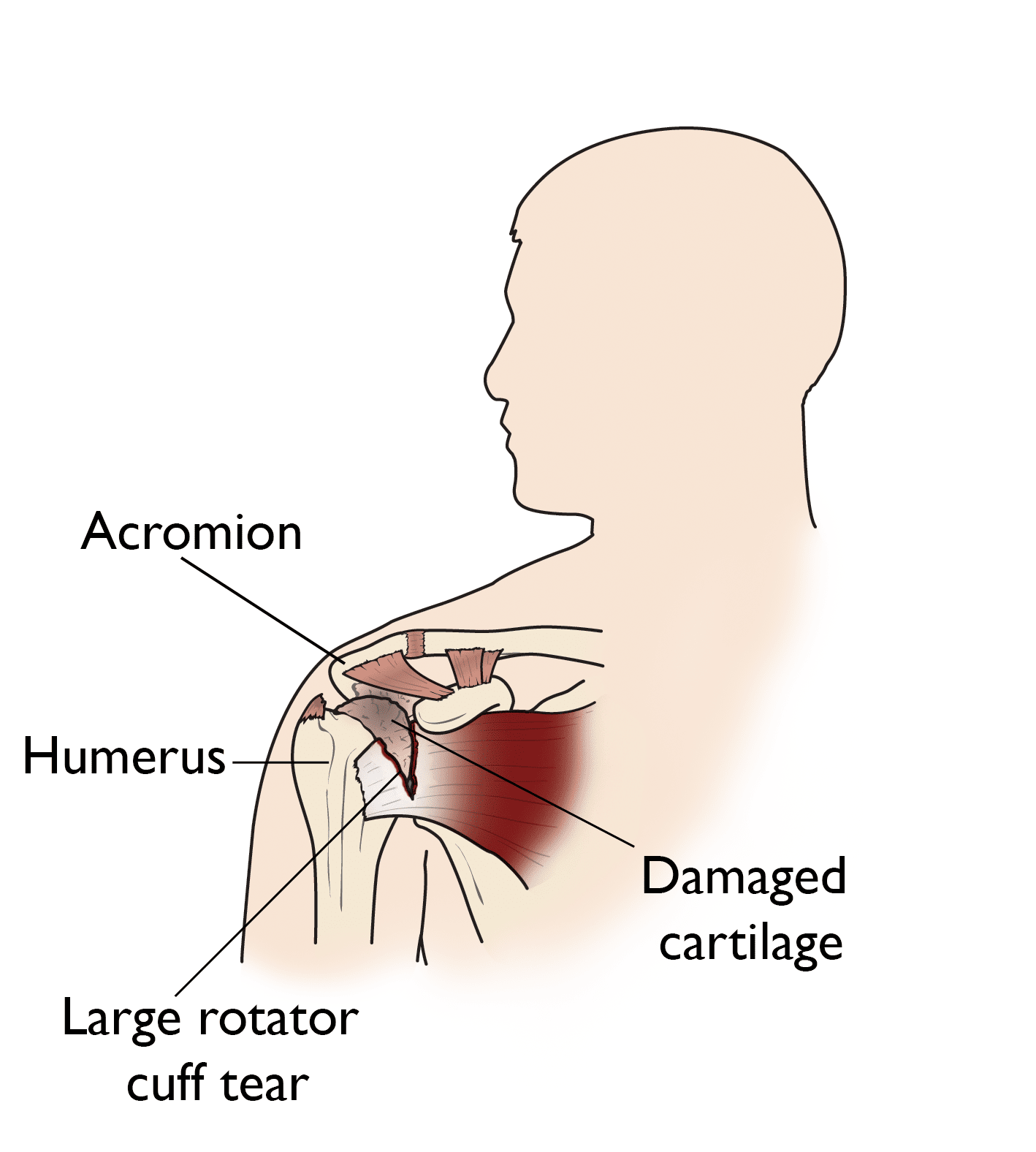 Illustration of rotator cuff arthropathy