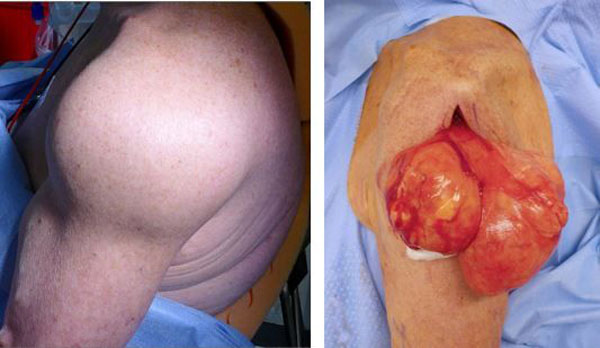Photos of a lipoma in the shoulder