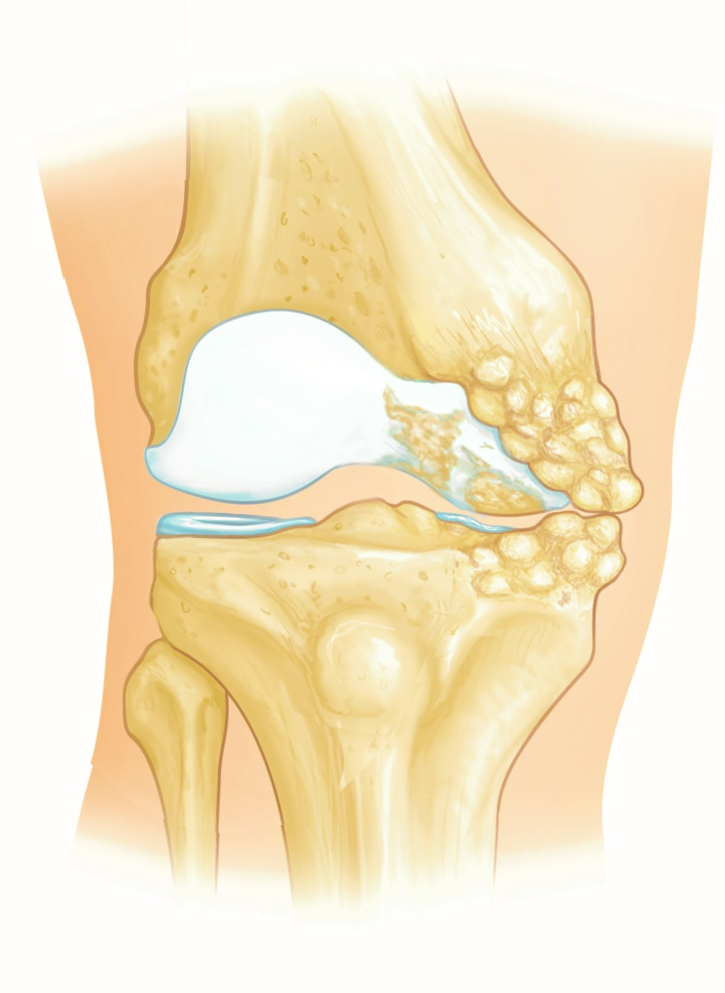 Osteoarthritis limited to medial compartment of the knee Osteoarthritis limited to medial compartment of the knee