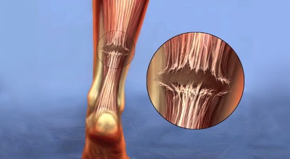 Calf Muscle Tightness, Achilles Tendon Length and Lower Leg Injury