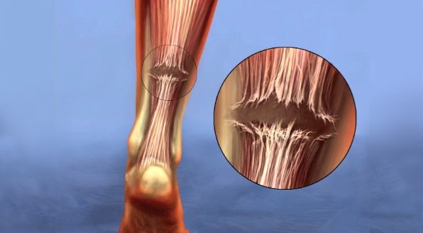 achilles-tendinitis-orthoinfo-aaos