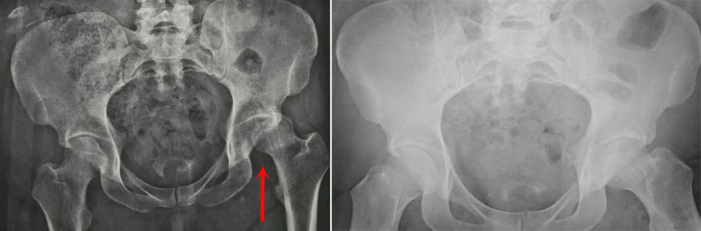X-rays of a dislocated hip before and after reduction