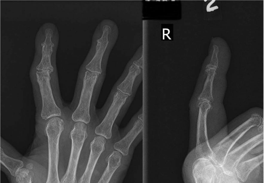 X-ray of patient with severe arthritis of the fingers