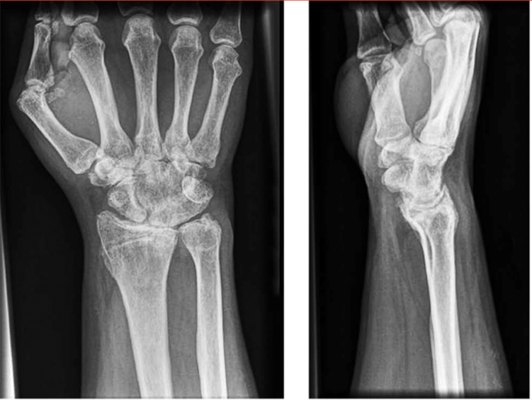 X-ray Showing Wrist Arthritis