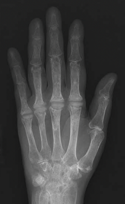X-ray showing MCP joint replacement with silicone implants