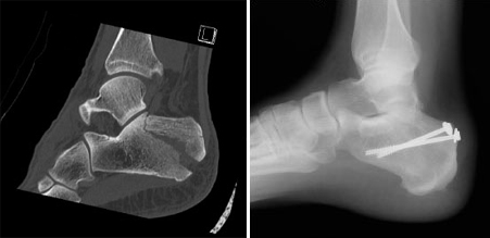 Screw fixation of calcaneus fracture