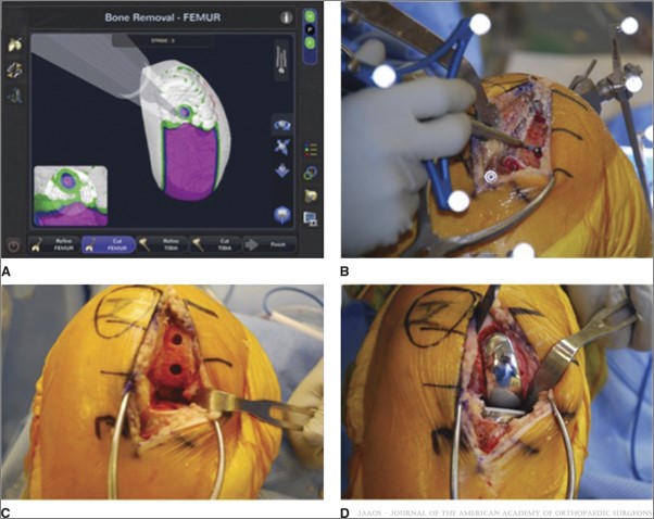 Robotic-Assisted Unicompartmental Knee Replacement Robotic-Assisted Unicompartmental Knee Replacement