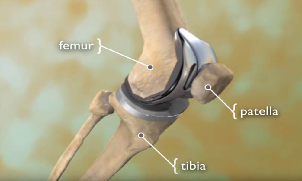 total knee replacement