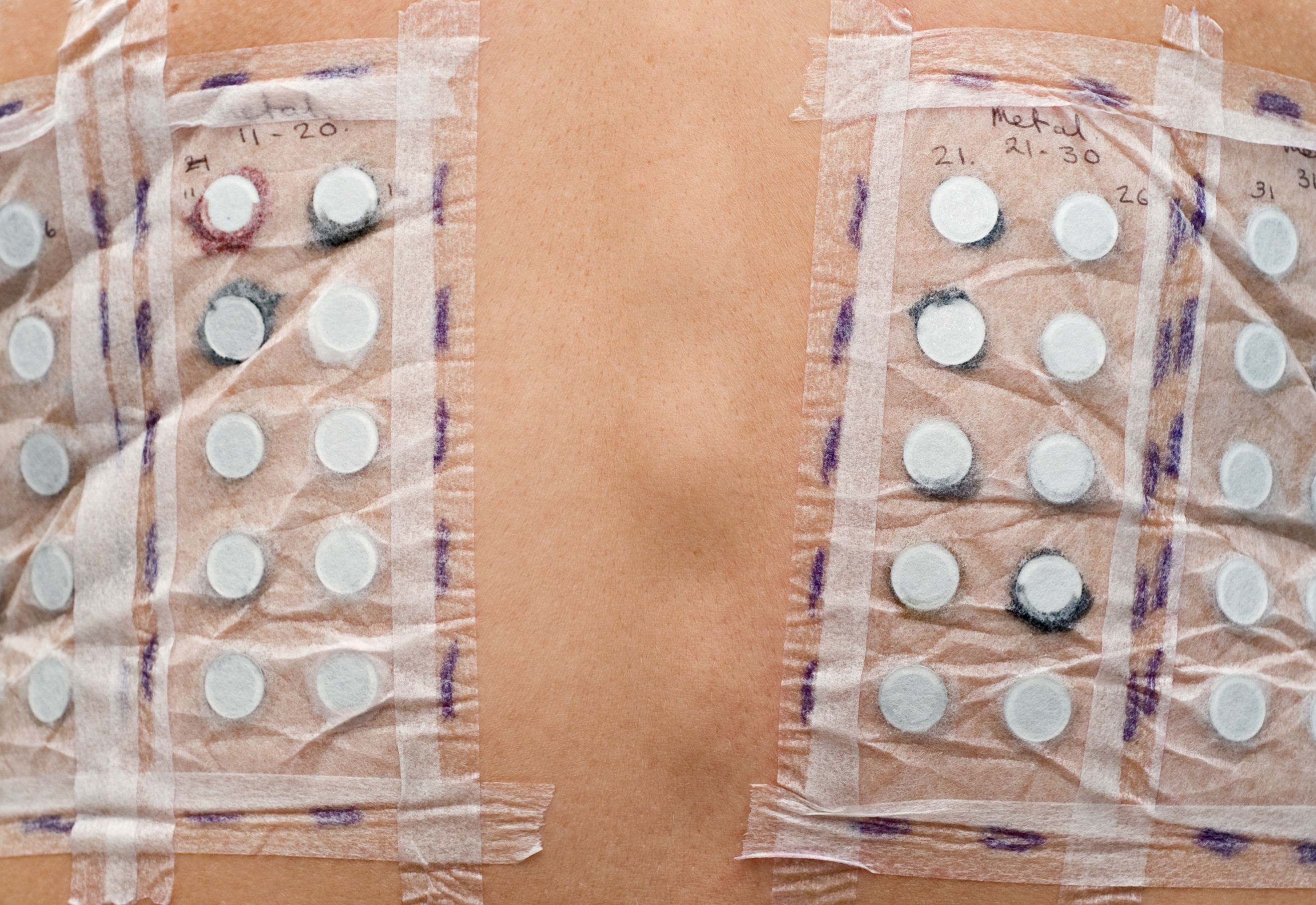 Skin Patch Testing