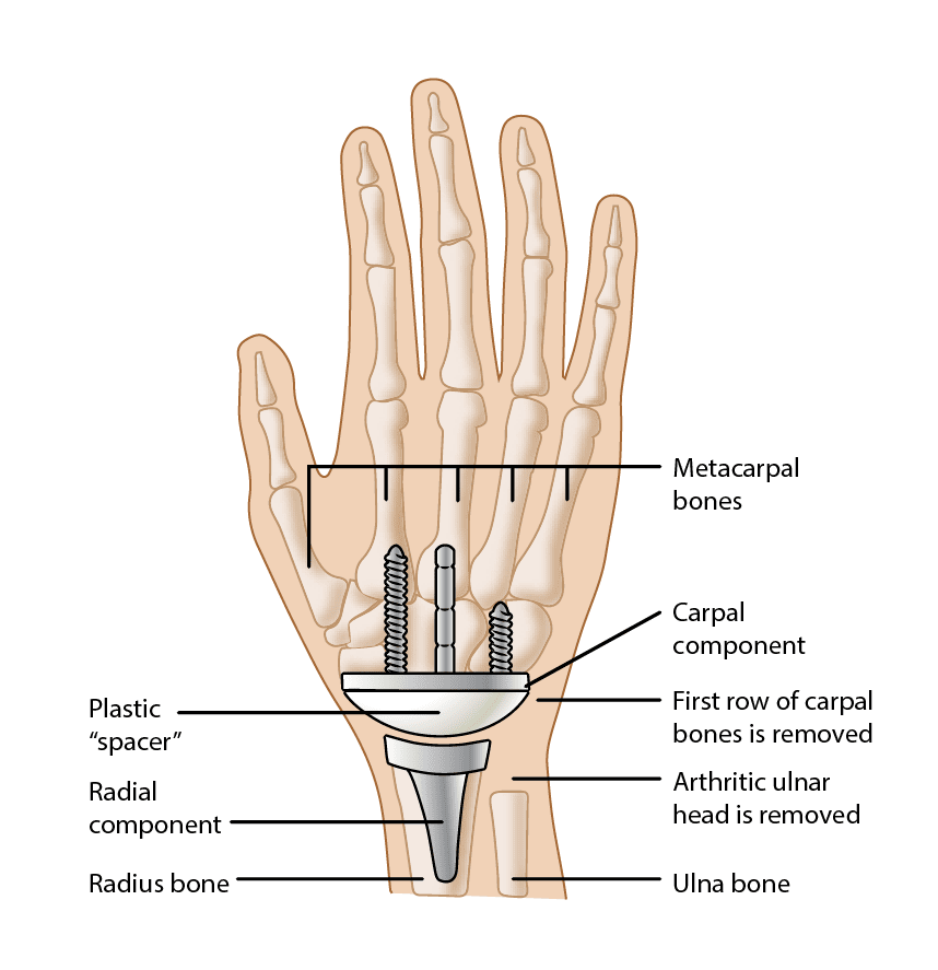 Components of a wrist arthroplasty