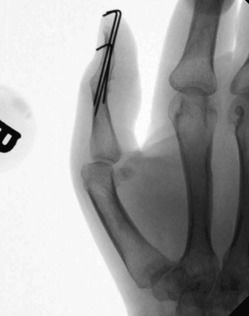 X-ray Showing Thumb Fusion