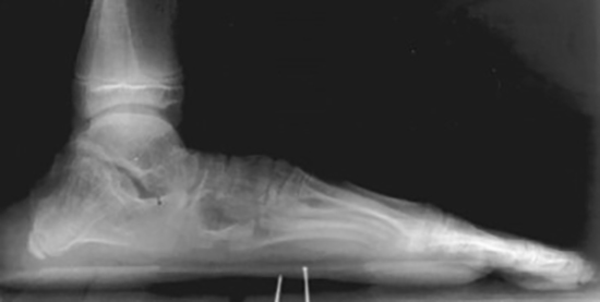 flat foot of patient with Marfan syndrome