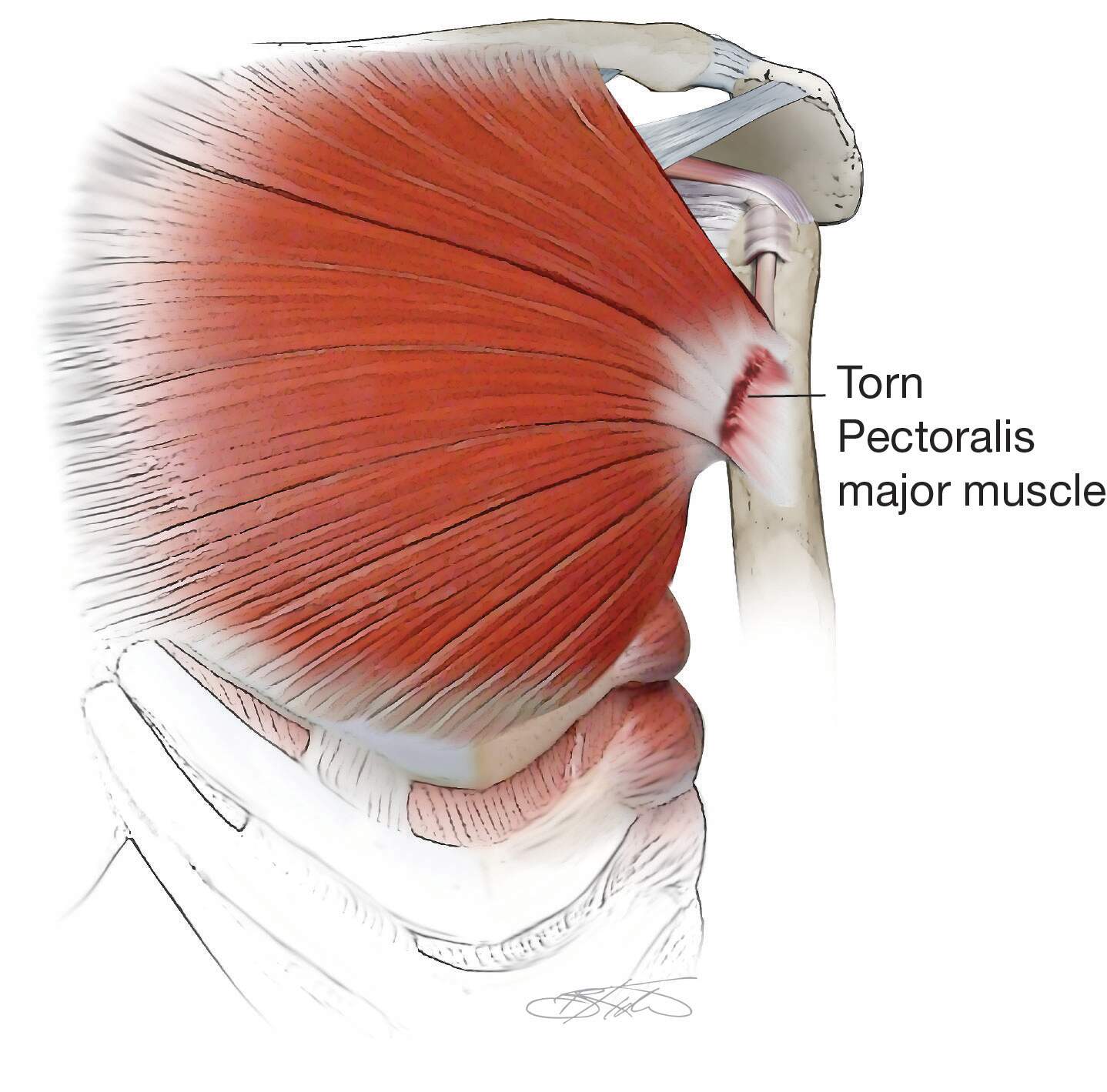 Illustration Showing a Pectoralis Tendon Tear