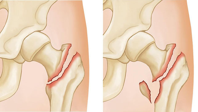 two- and three-part intertrochanteric fractures