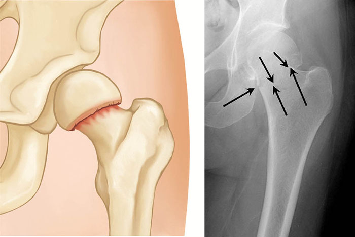 femoral neck fracture