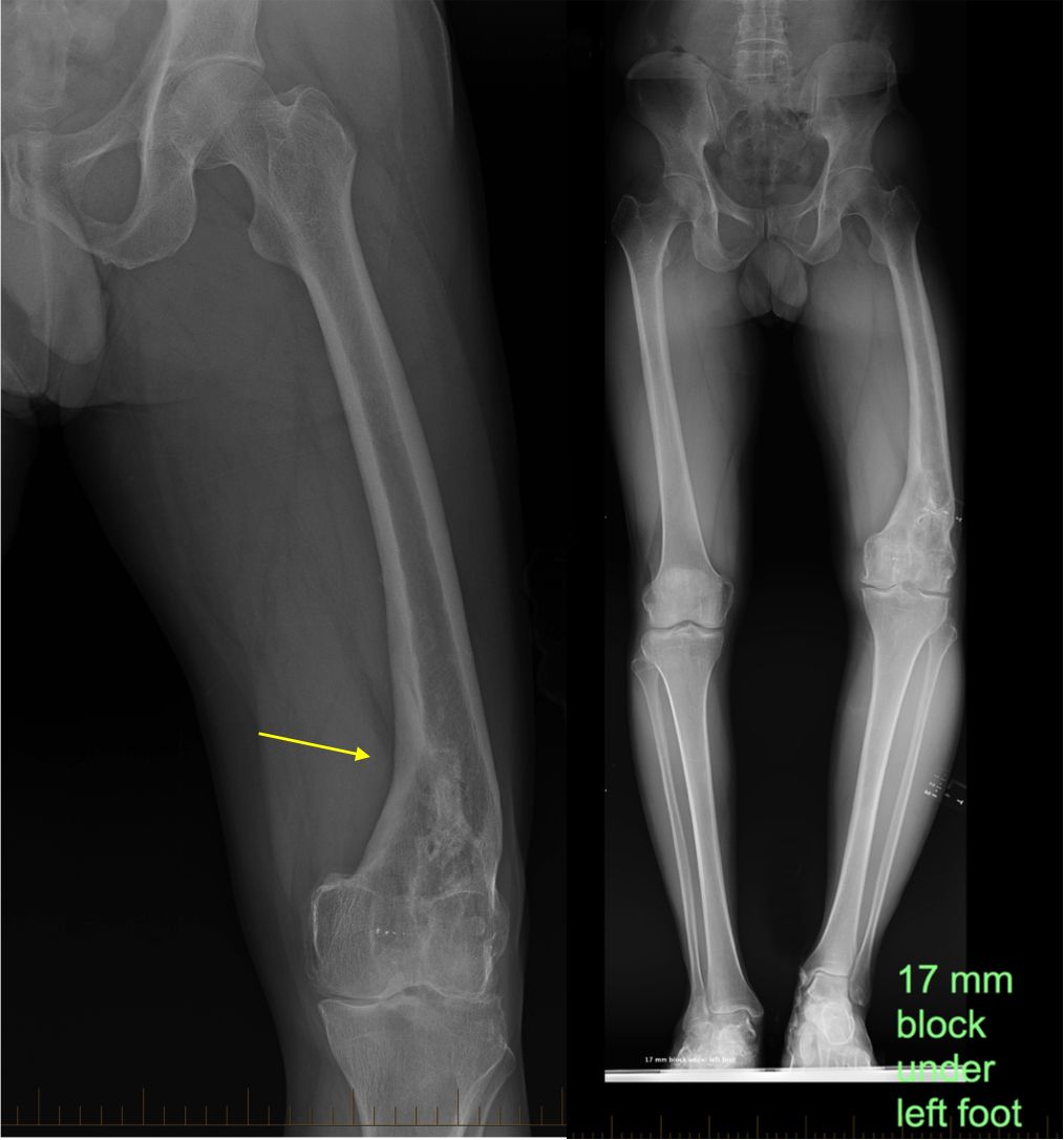 malunion and leg length discrepancy