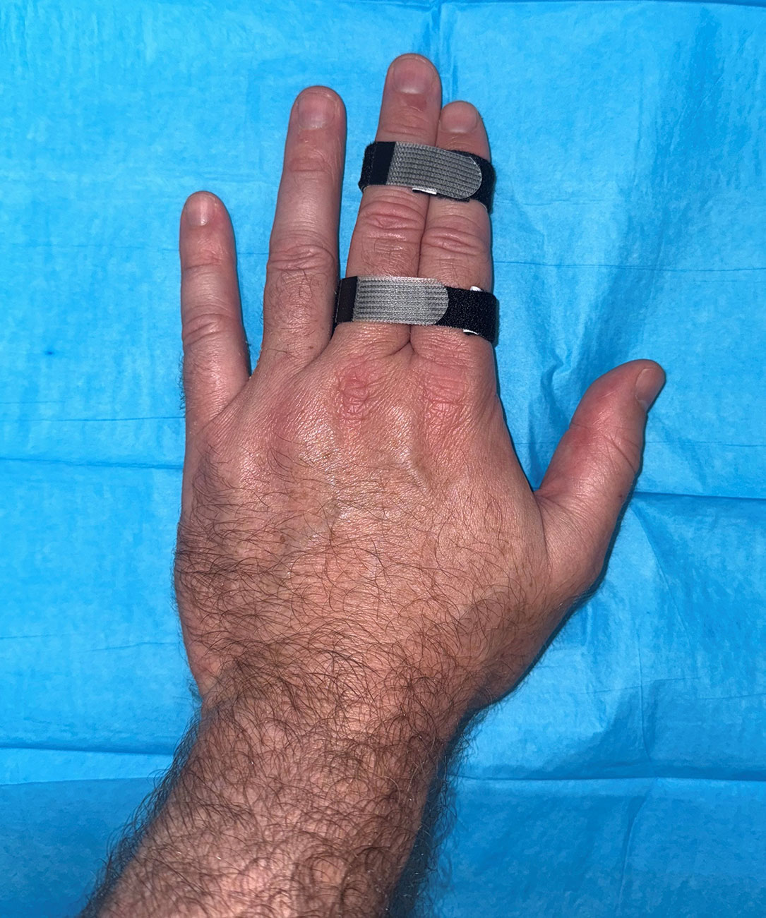Buddy Strapping of Sprained Finger