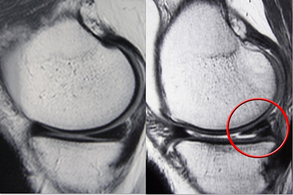 Healthy and Torn Meniscus