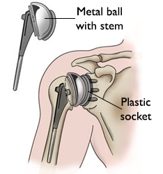 Illustration Showing Total Shoulder Replacement