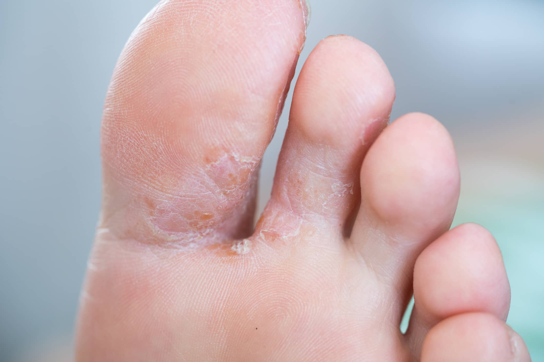 athlete's foot