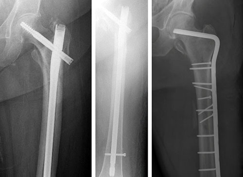 treatment options for subtrochanteric fracture