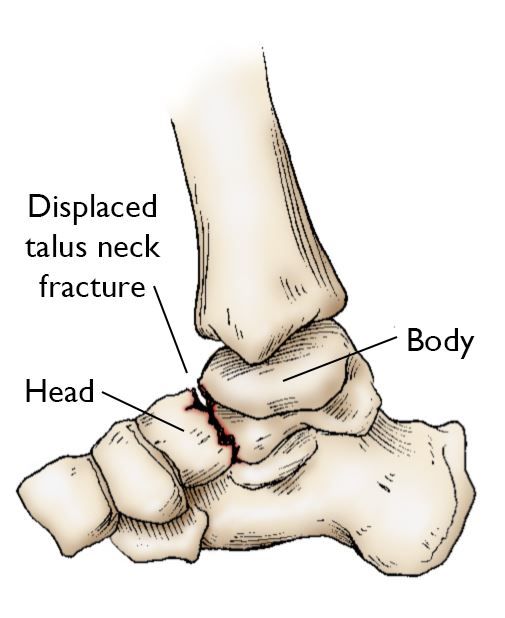 Talus neck fracture Talus neck fracture