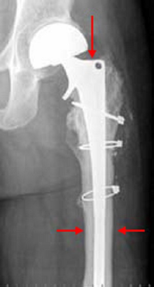 Reconstruction of hip joint after Ewing's sarcoma
