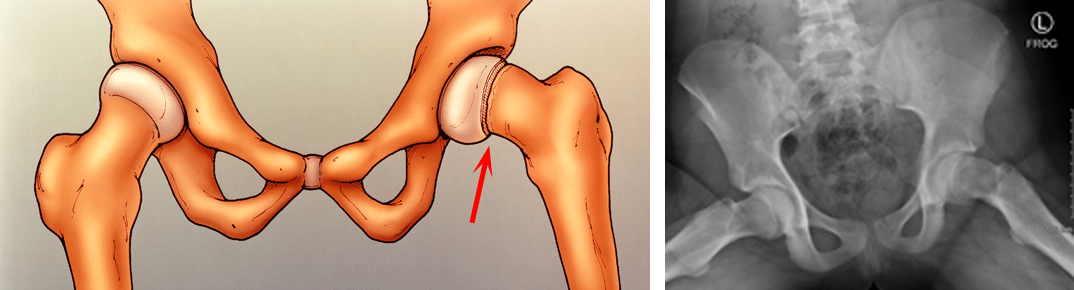 Illustration of SCFE