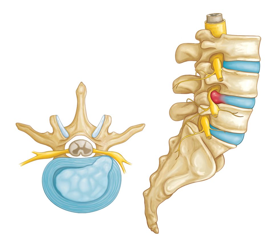 Herniated Back image