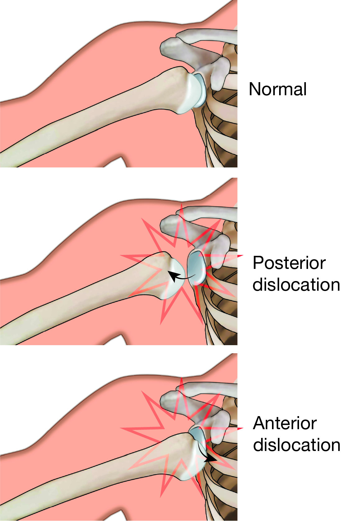 Illustration of normal shoulder stability and shoulder dislocation 
