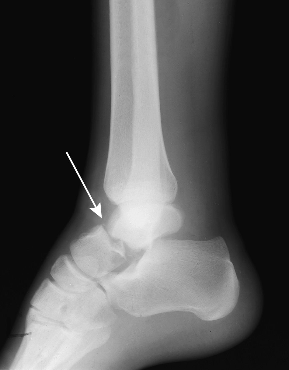 X-ray of a talus neck fracture.  X-ray of a talus neck fracture.