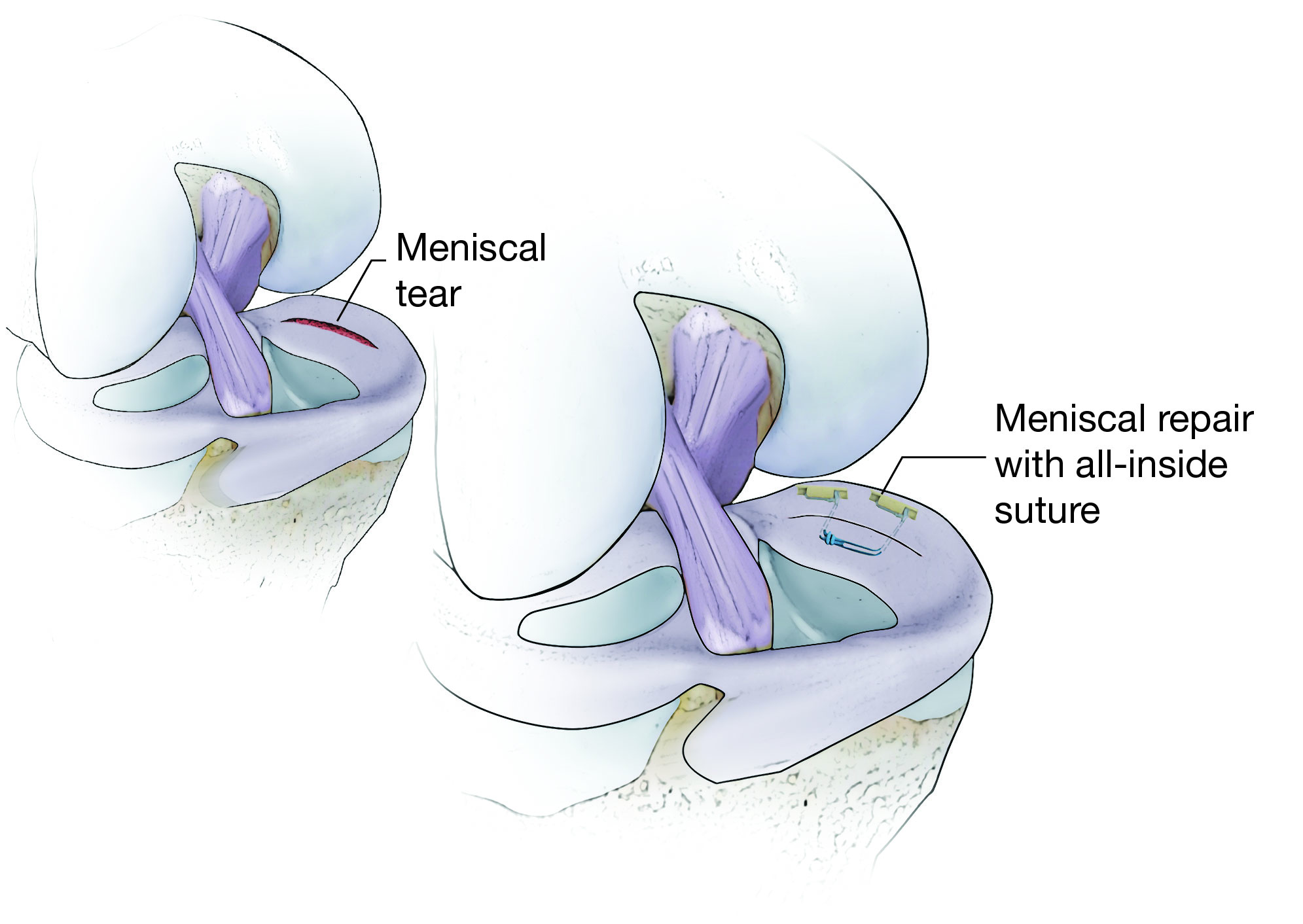 Illustration Showing All-Inside Meniscus Repair