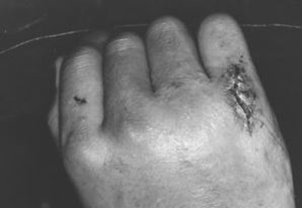 Human bite on hand