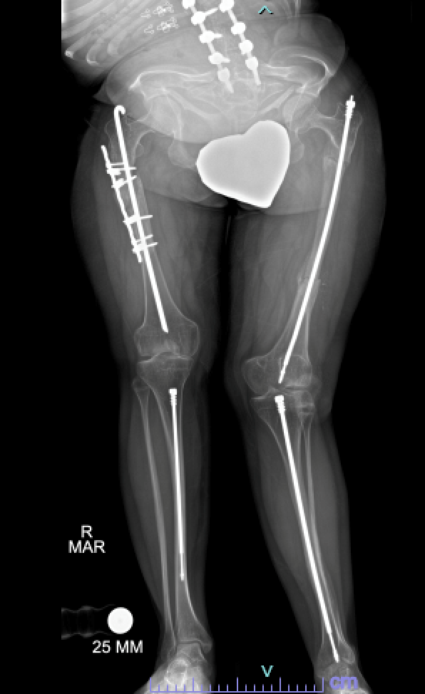 X-ray showing intramedullary rods in the legs of a patient with osteogenesis imperfecta