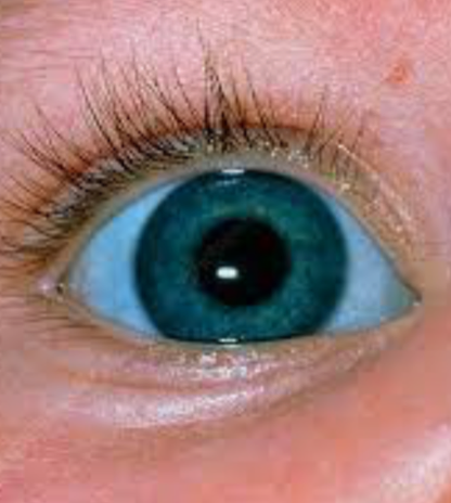 Blue sclerae (whites of eyes) in a patient with osteogenesis imperfecta