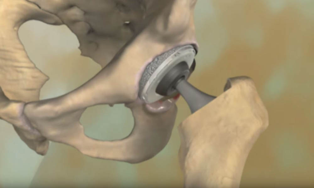 Osteoartritis de rodilla (Knee Osteoarthritis) - OrthoInfo - AAOS