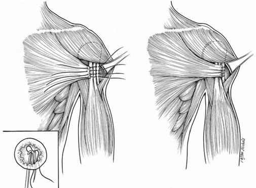 Illustration Showing Pectoralis Tendon Repair Procedure