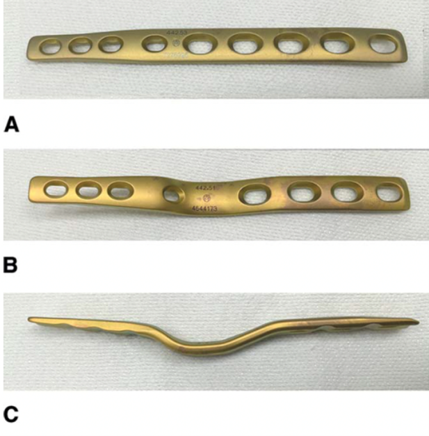 Photo Showing Wrist Fusion Implants (Plates)