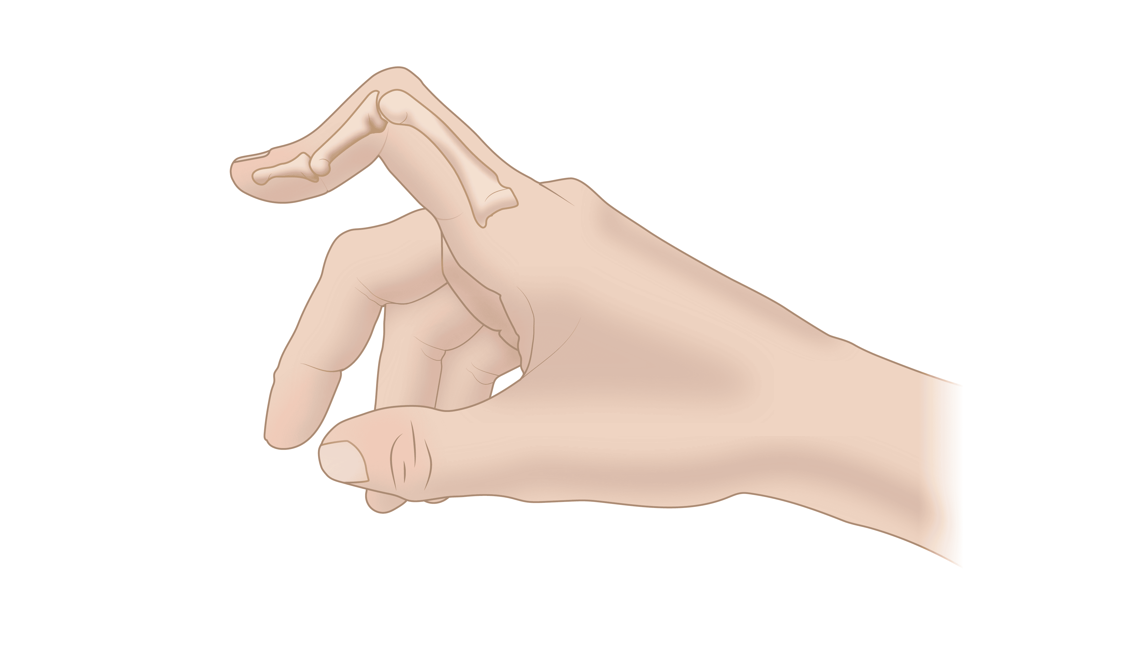 Boutonnière deformity