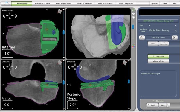 CT Scan for Robotic-Assisted Joint Replacement Planning CT Scan for Robotic-Assisted Joint Replacement Planning