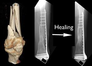 femur break elderly recovery femur break elderly recovery