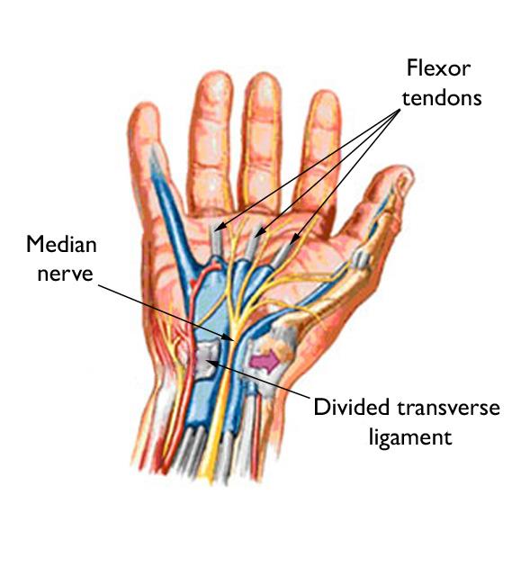 Carpal tunnel release surgery