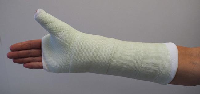 scaphoid fracture cast