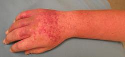 Acute stage of CRPS