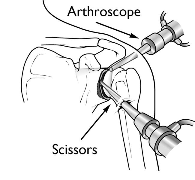 cirugía artroscópica
