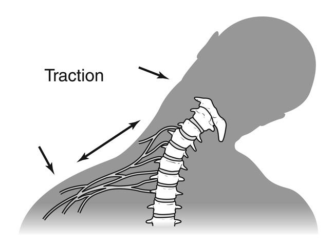 Brachial plexus injury